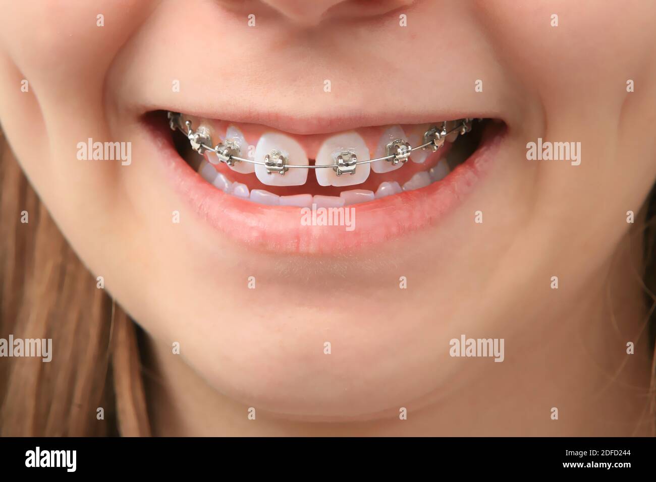 Orthodontics Stock Photo