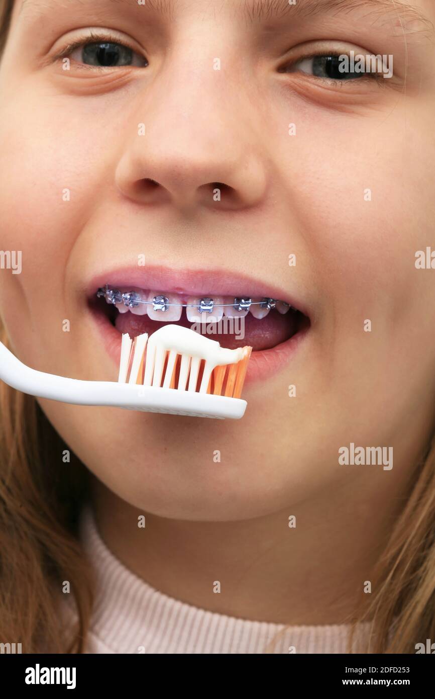 Braces, tooth brushing Stock Photo