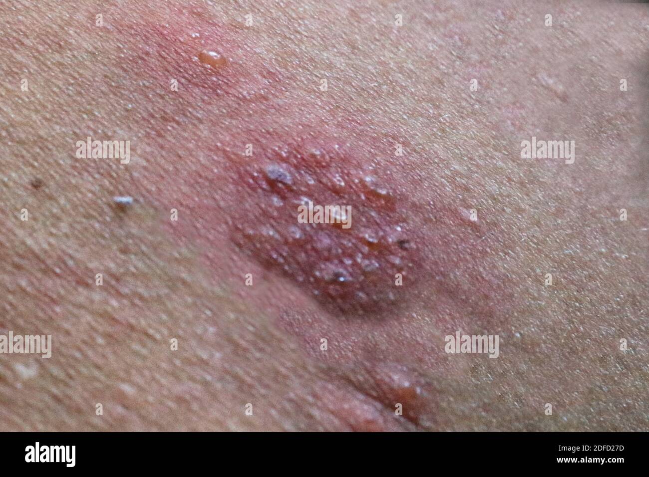 Shingles rash hi res stock photography and images alamy
