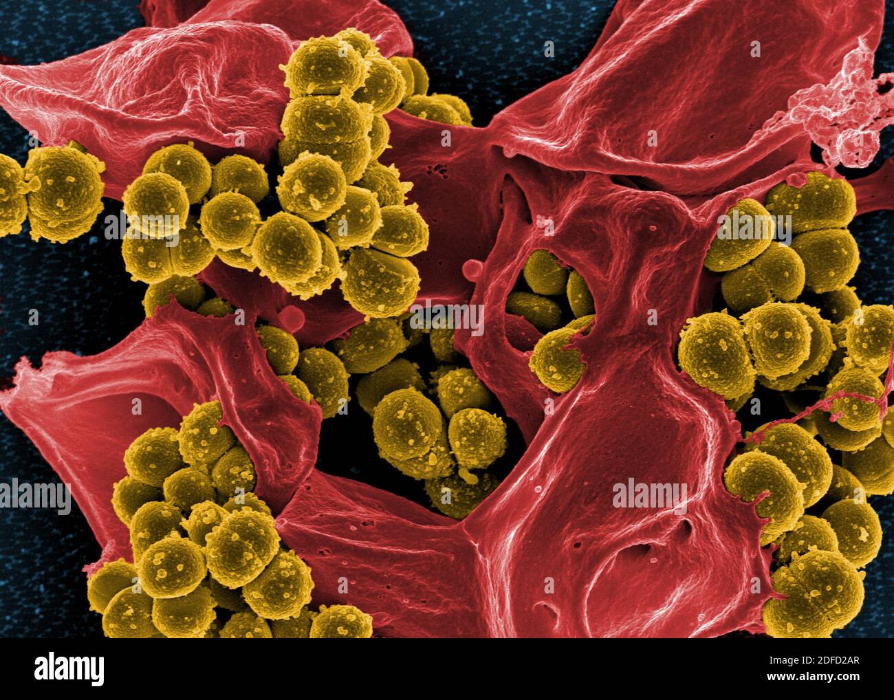Scanning electron micrograph of methicillin-resistant Staphylococcus aureus and a dead human neutrophil. Credit: NIAID. Stock Photo