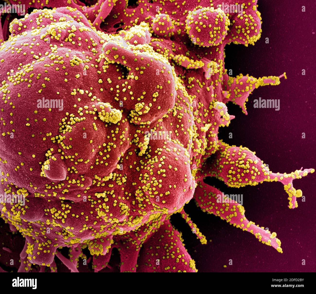 Colorized scanning electron micrograph of an apoptotic cell (red) heavily infected with SARS-COV-2 virus particles (yellow), isolated from a patient s Stock Photo