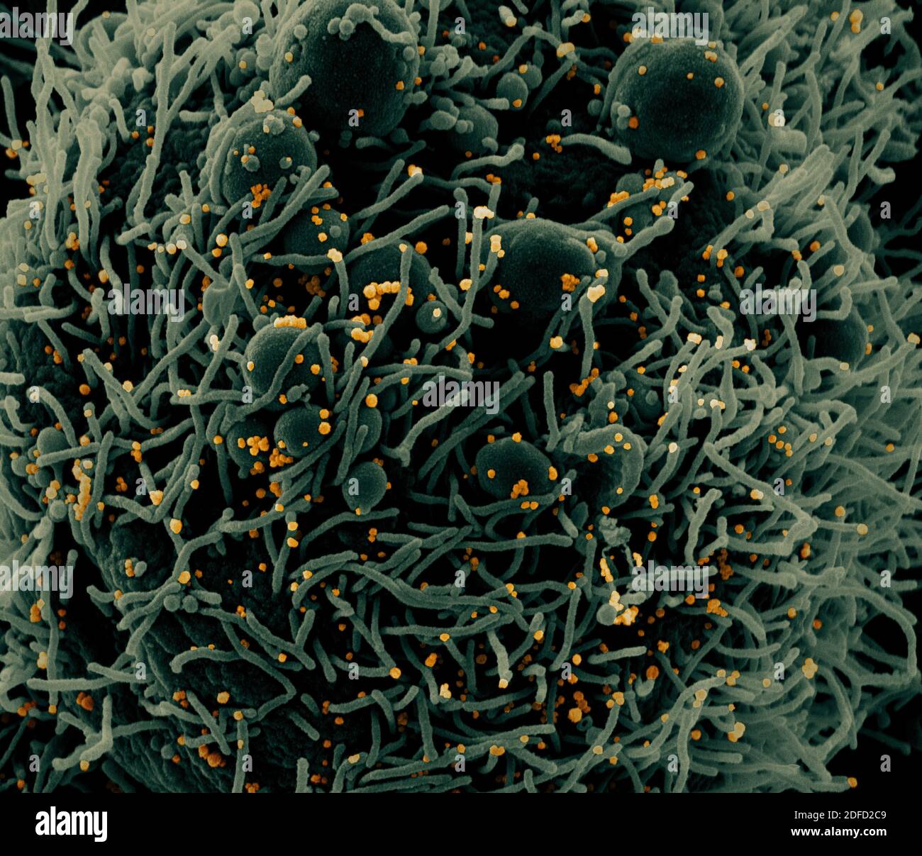 Colorized scanning electron micrograph of an apoptotic cell (green ...