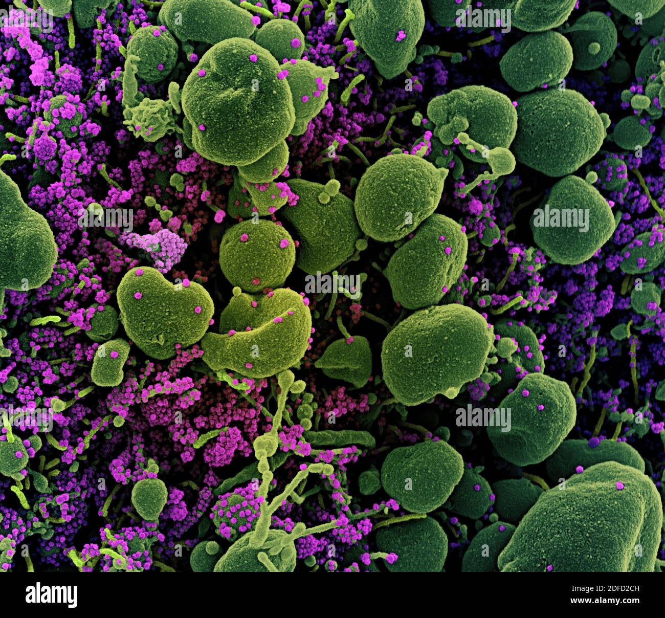 Colorized scanning electron micrograph of an apoptotic cell (green ...