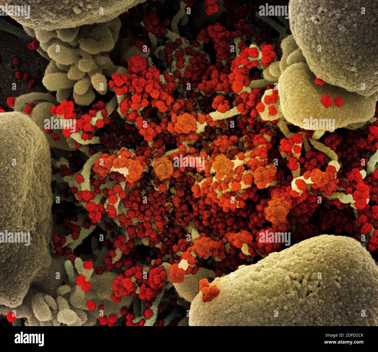 Colorized scanning electron micrograph of an apoptotic cell (tan) heavily infected with SARS-CoV-2 virus particles (orange), isolated from a patient s Stock Photo