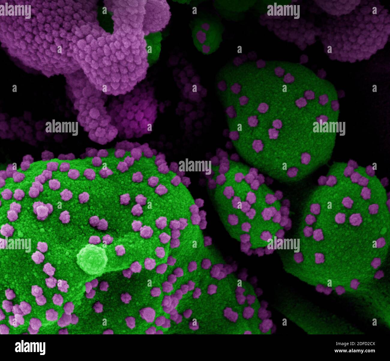 Colorized scanning electron micrograph of an apoptotic cell (green) heavily infected with SARS-CoV-2 virus particles (purple), isolated from a patient Stock Photo