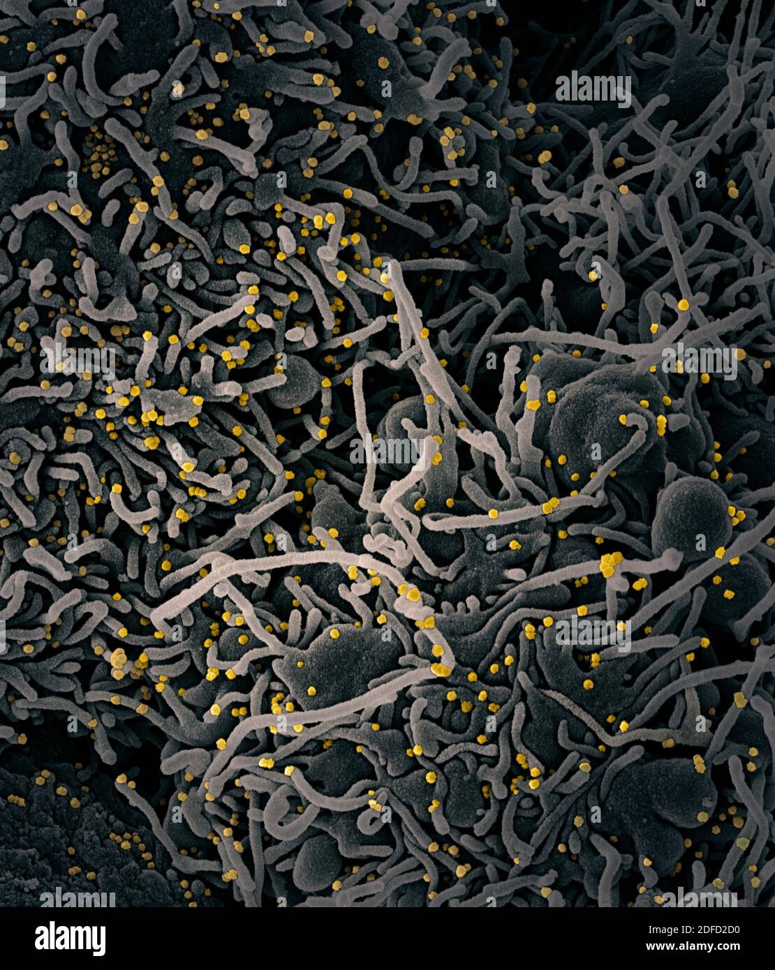 Colorized scanning electron micrograph of a VERO E6 cell (gray) exhibiting elongated cell projections and signs of apoptosis, after infection with SAR Stock Photo