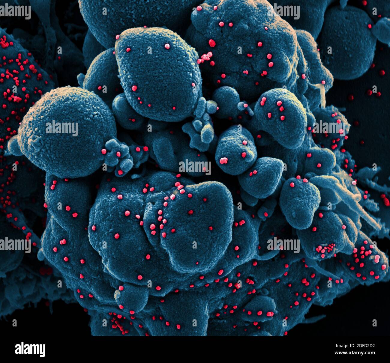 Colorized scanning electron micrograph of an apoptotic cell (blue) infected with SARS-COV-2 virus particles (red), isolated from a patient sample. Ima Stock Photo