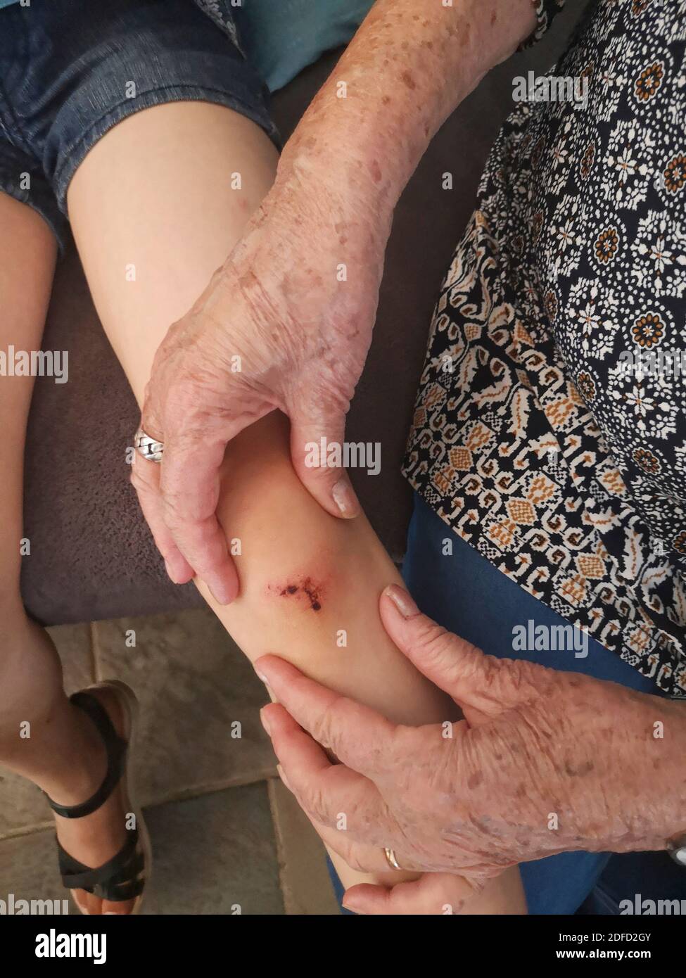 Liver Spots High Resolution Stock Photography And Images Alamy Liver Spots High Resolution Stock Photography And Images Alamy