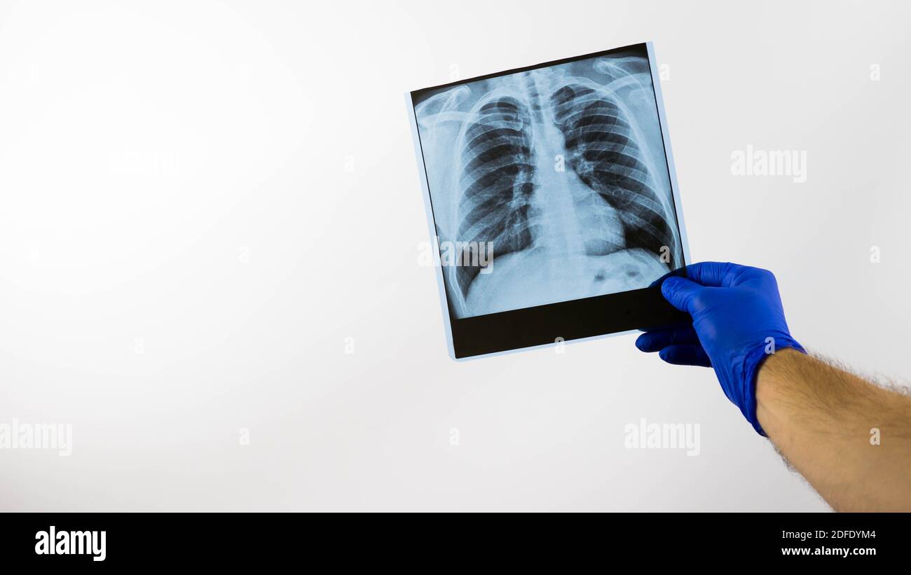 Xray of holes in a medical professional,pneumonia of the lungs,edema