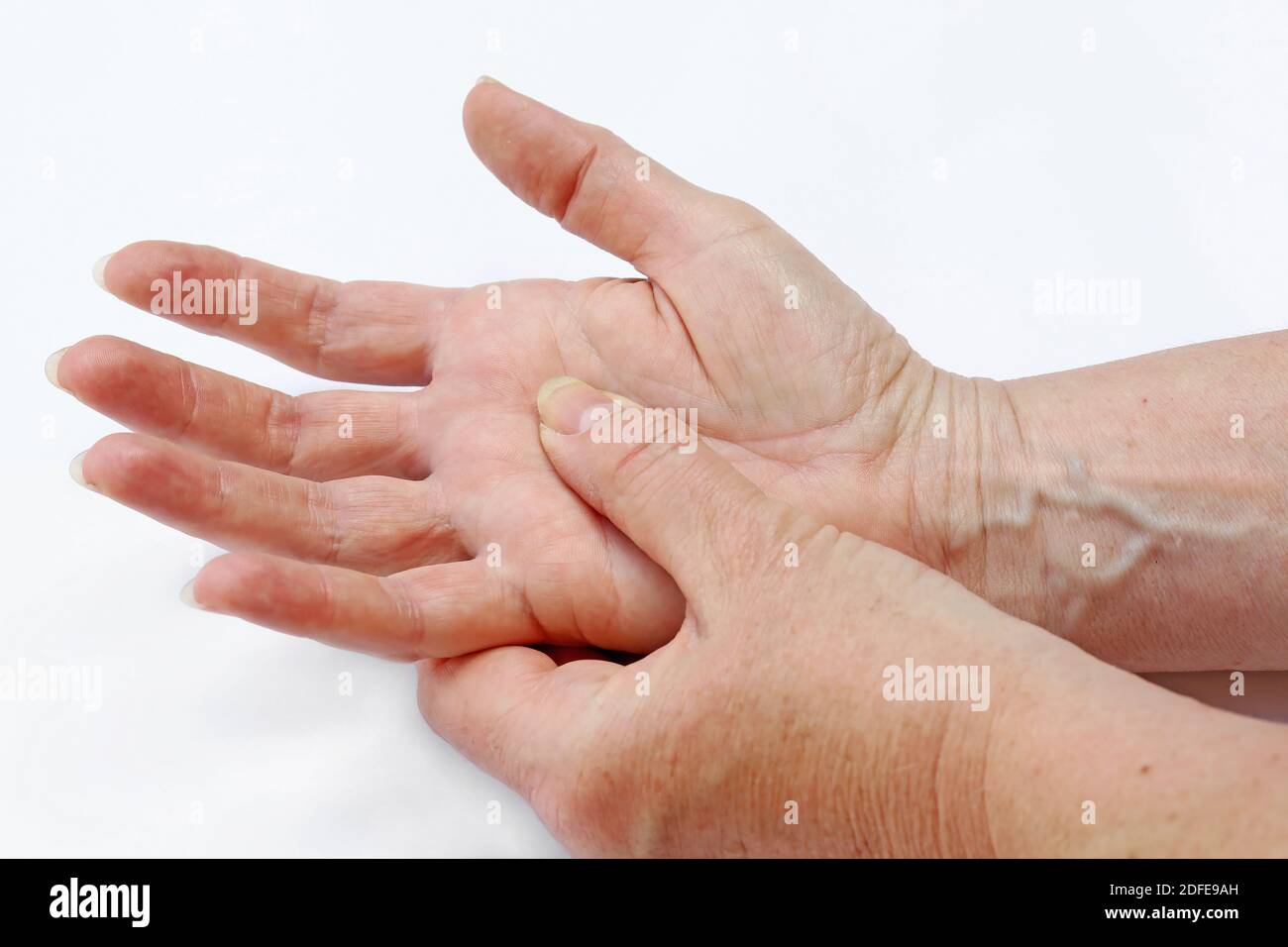 Neurodermatitis hires stock photography and images Alamy