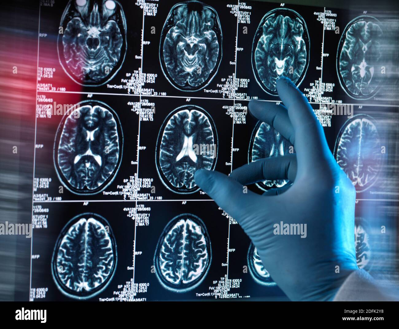 Neurological examination hi res stock photography and images Alamy Neurological examination hi res stock photography and images Alamy