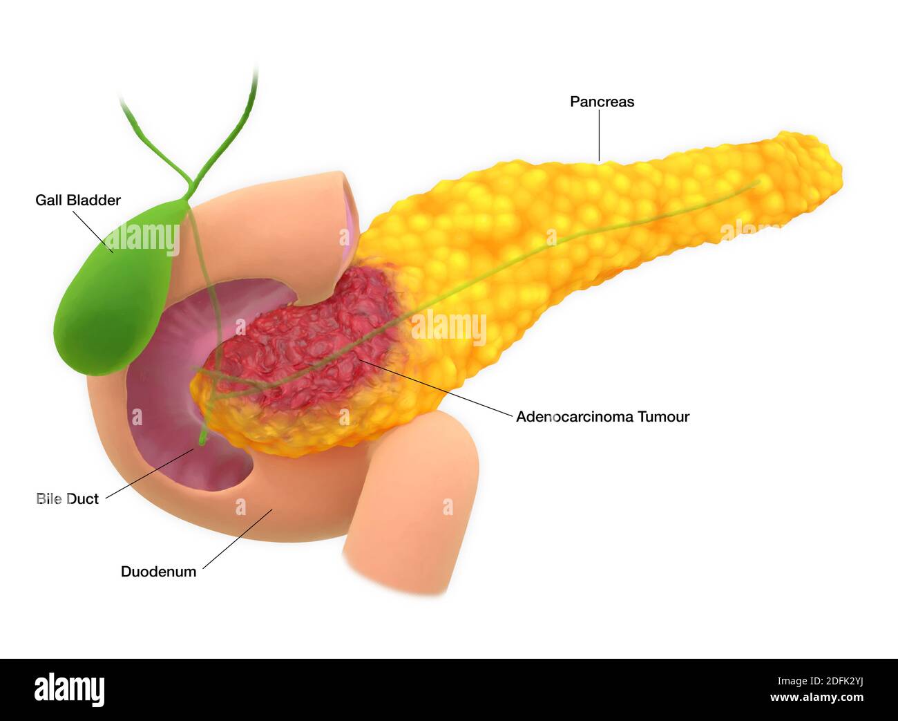 Pancreatic Adenocarcinoma Illustration Stock Photo Alamy pancreatic-adenocarcinoma-illustration-stock-photo-alamy