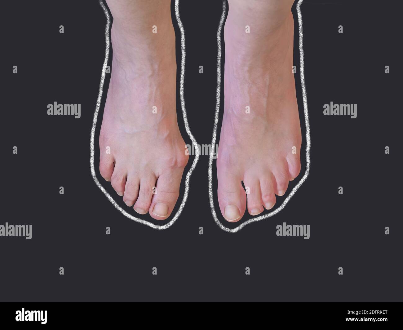 Chalk outline of hallux valgus, bunion in woman foot on black background. Overhead shot with copy space. Stock Photo