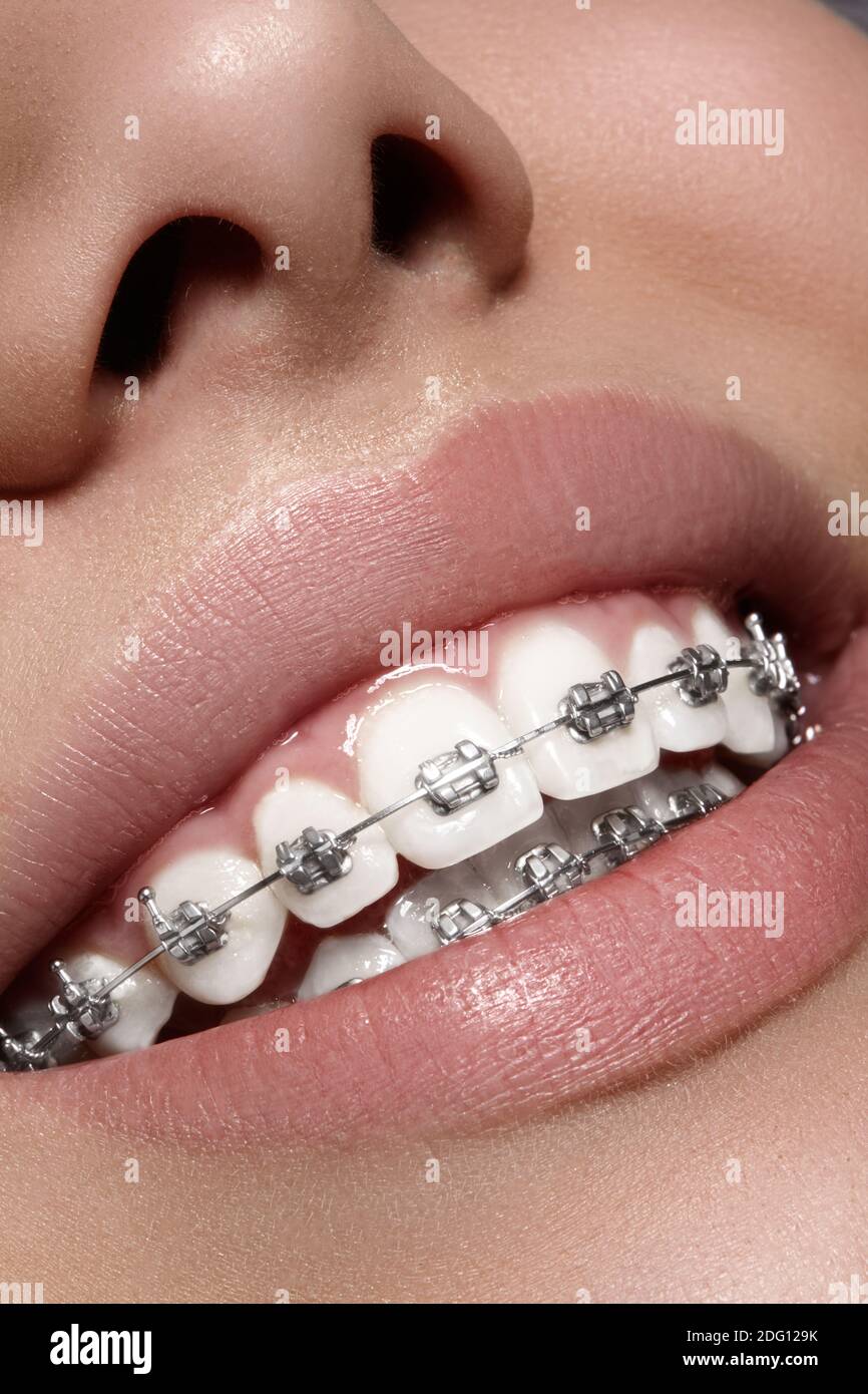 Orthodontic brackets hires stock photography and images Alamy
