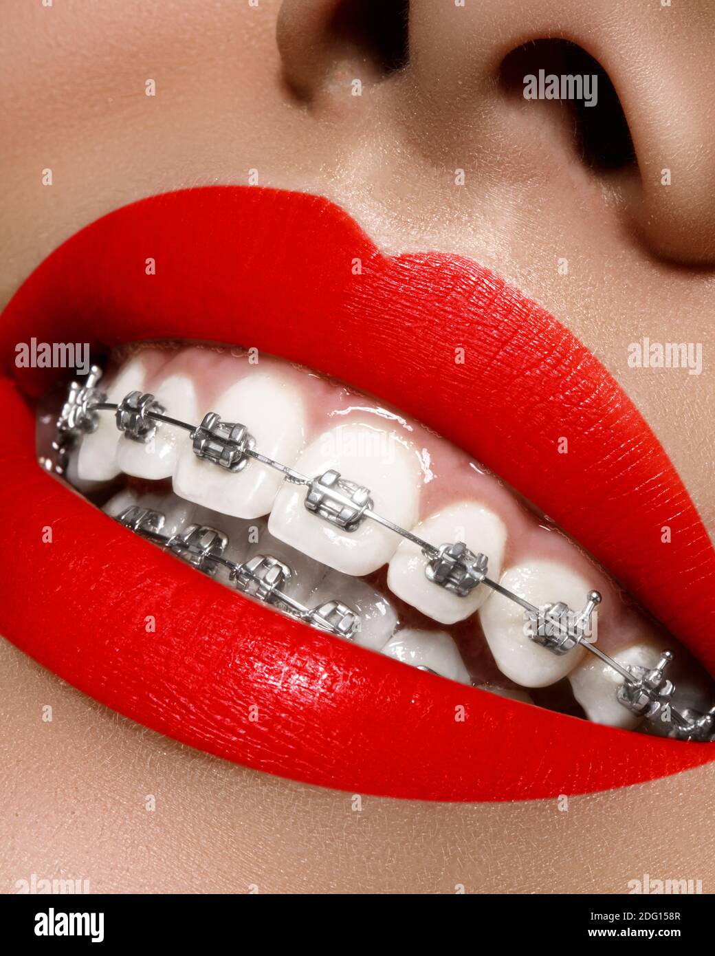 Orthodontic brackets hires stock photography and images Alamy