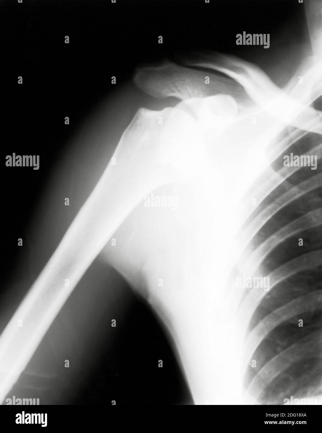 Shoulder surgery hires stock photography and images Alamy