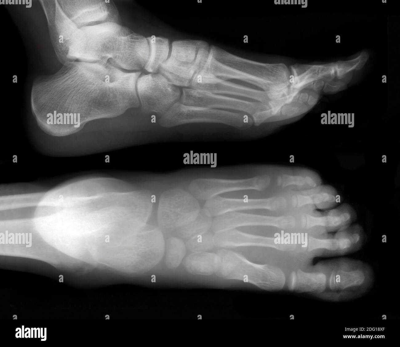 Foot-X-Ray cutout Stock Photo