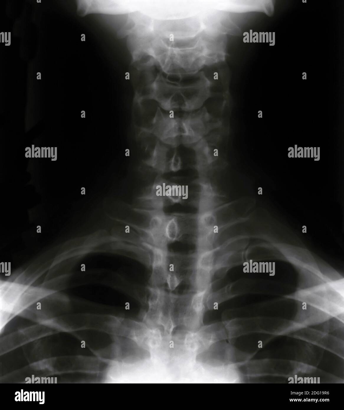 X ray Neck Stock Photo