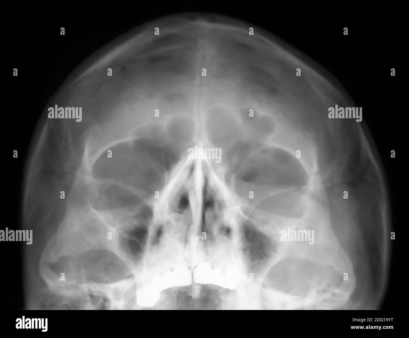 Head x ray Stock Photo