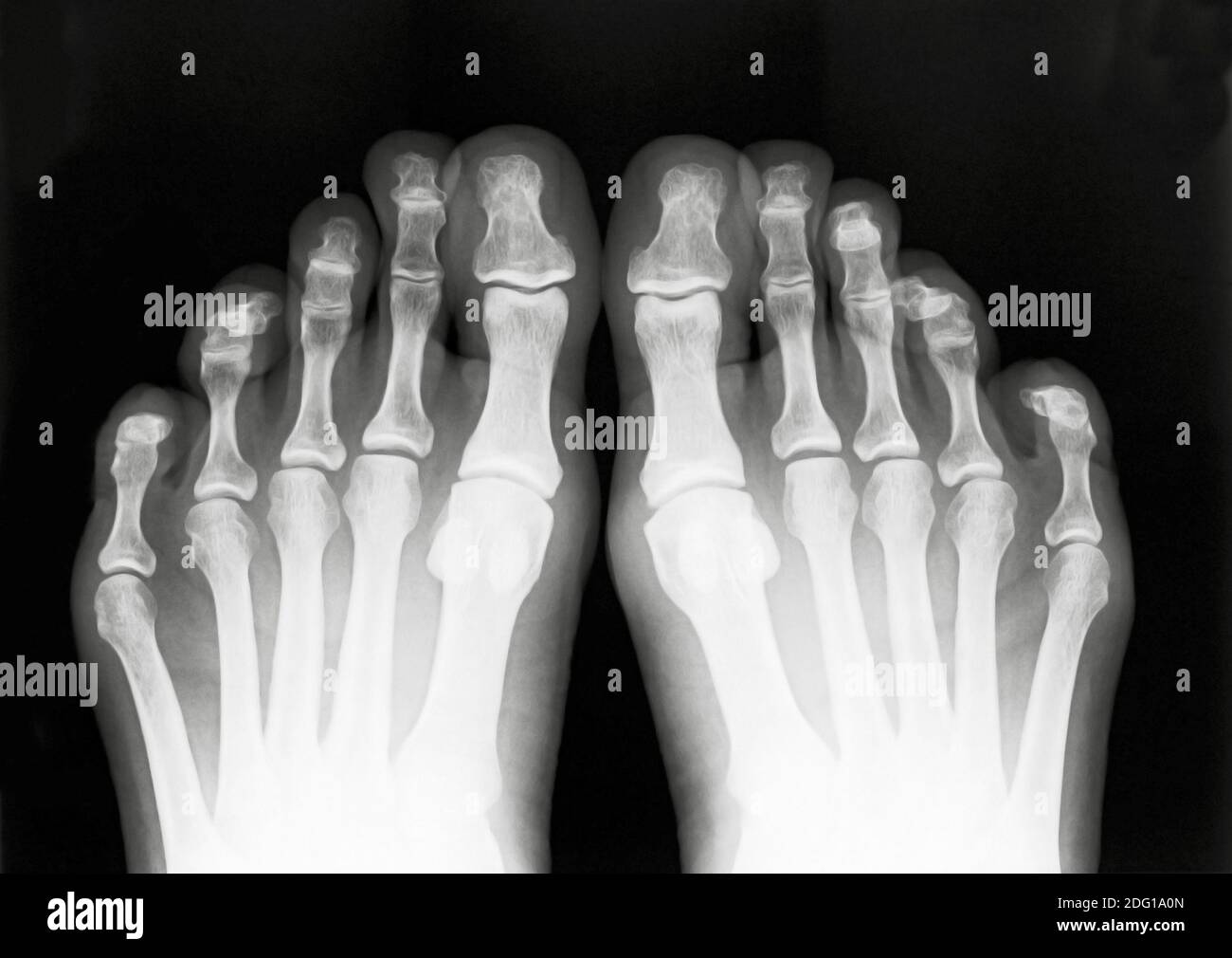 X ray image of Foot fingers Stock Photo
