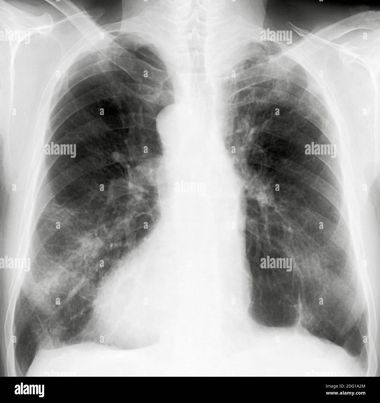 X-Ray lungs Stock Photo