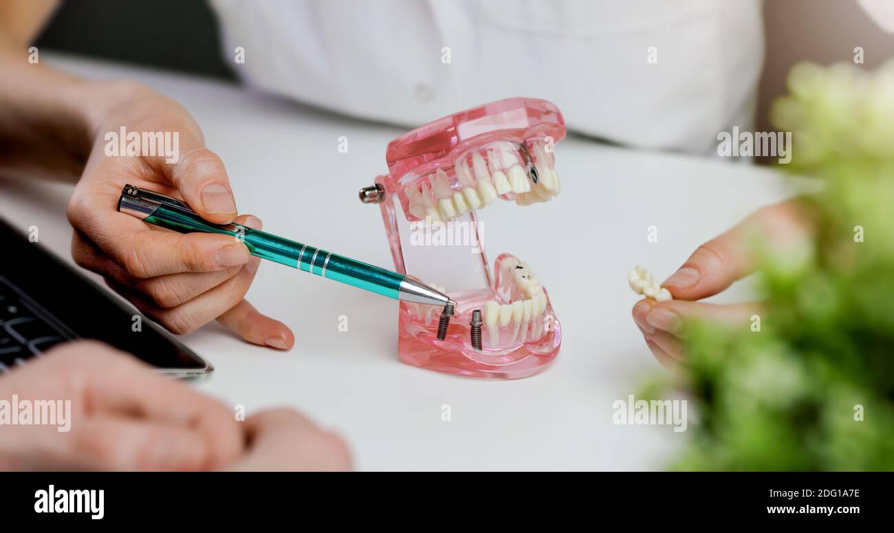 dentist implantologist showing dental implant technology on tooth jaw model to patient. visit in clinic office Stock Photo