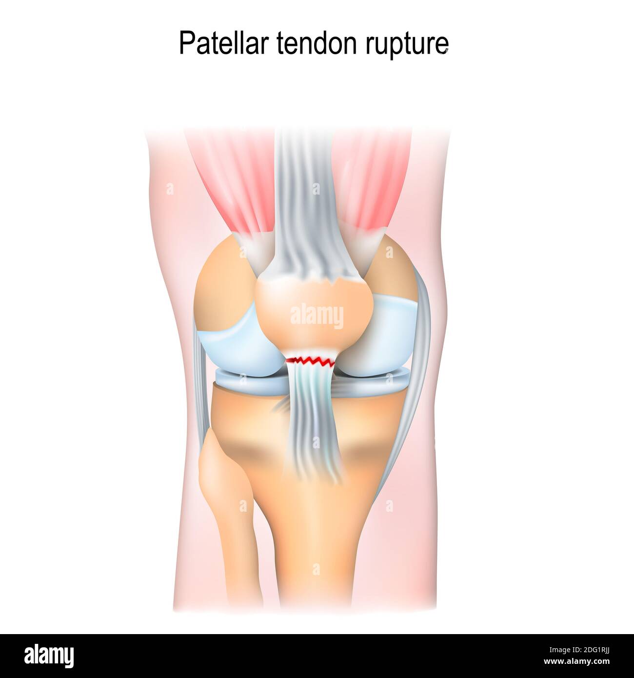Patellar tendon rupture. Knee joint with patella and Tendon Tears. Stock Photo
