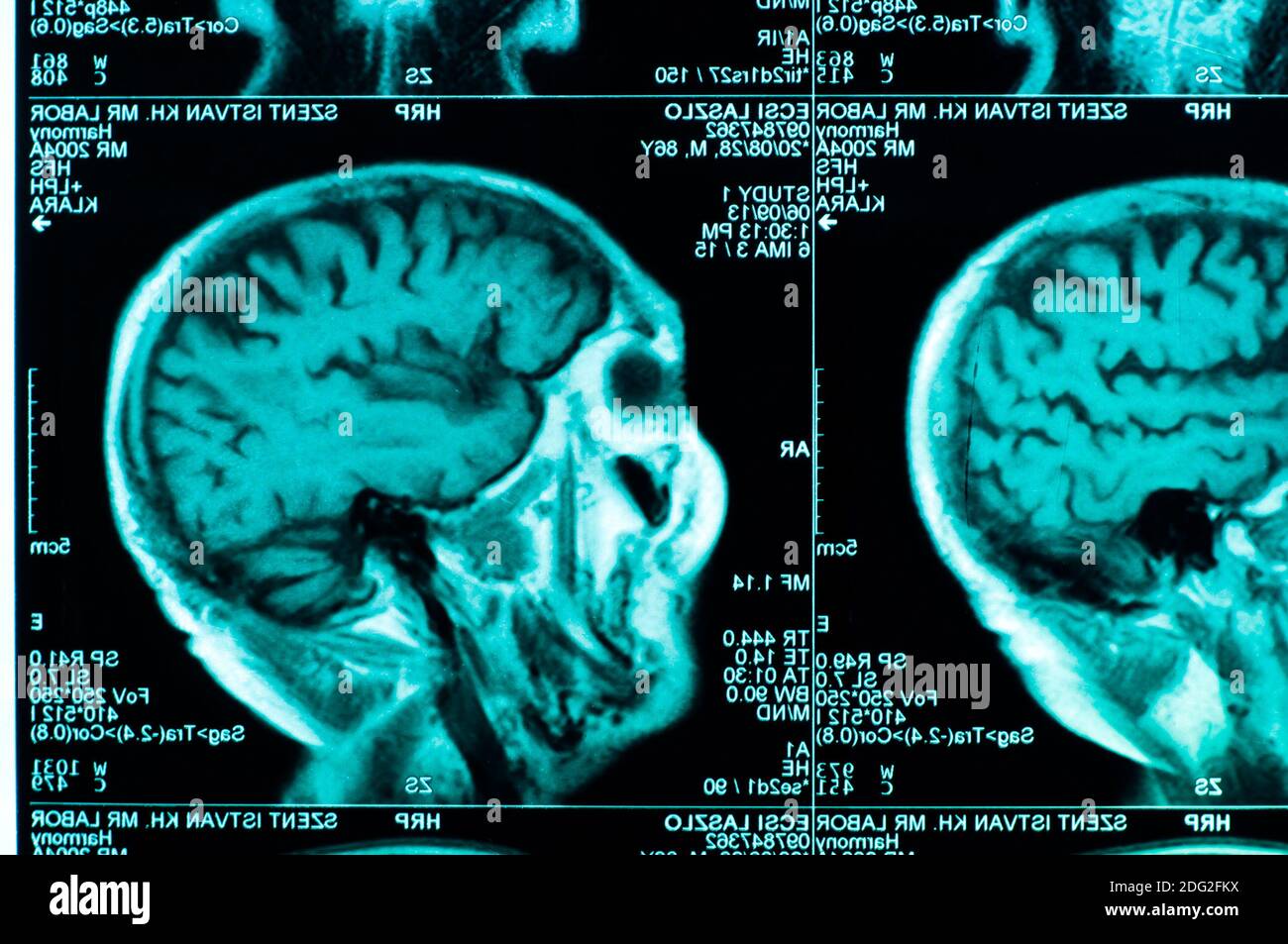 Mri scan head injury hires stock photography and images Alamy