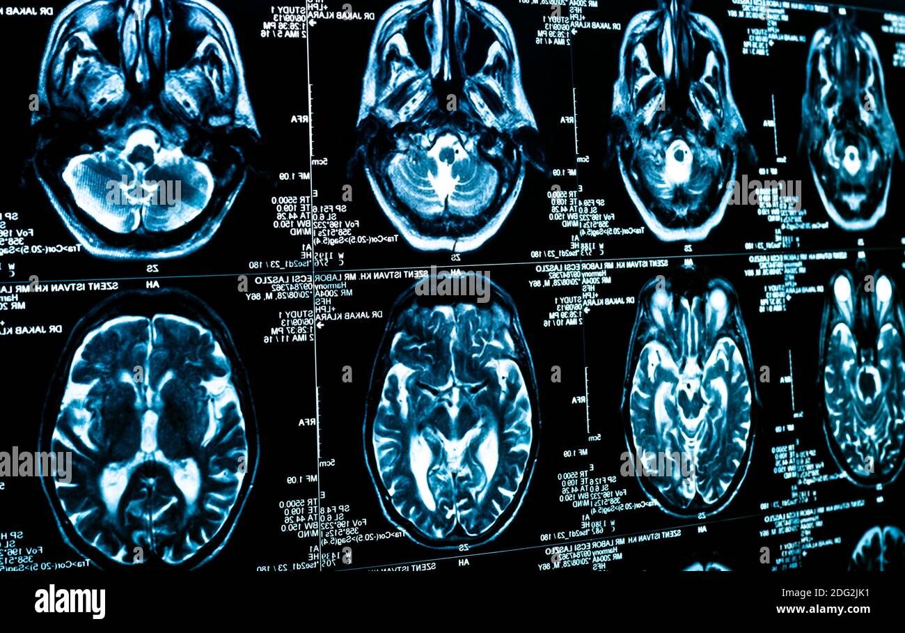 Ct scan brain cross section hi-res stock photography and images - Alamy