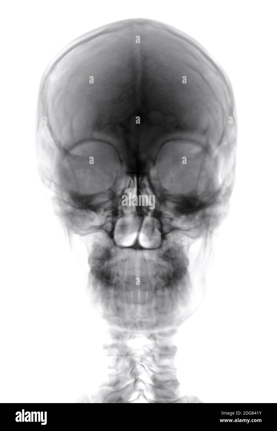 Human Head Xray Cutout Stock Photo