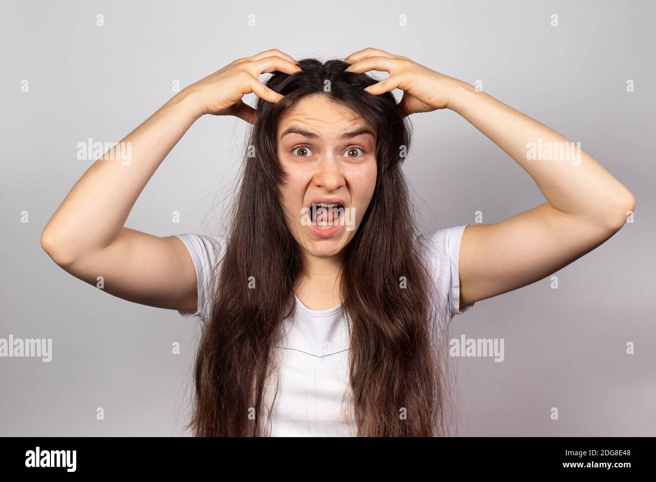 The girl grabbed her head and screams for problems with dandruff and hair loss. Scalp fungus, stress and baldness, skin itching. Stock Photo