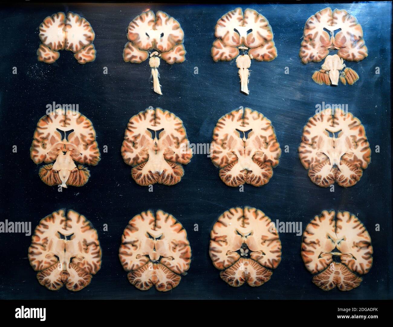 Präparat, Plastinat, Querschnitte durch das menschliche Gehirn,   Menschen Museum, Berlin, Deutschland Stock Photo