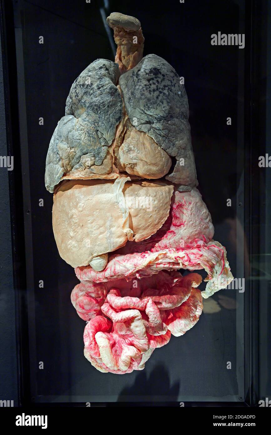 Präparat, Plastinat, innere Organe mit Metastasen,  Menschen Museum, Berlin, Deutschland Stock Photo