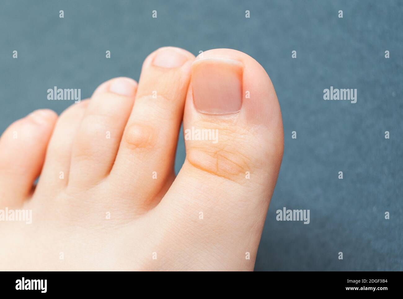 A young woman has hard corns on her toes from wearing shoes that don't fit properly and uncomfortable. Female foot. Closeup view. Stock Photo