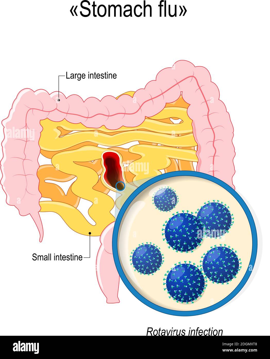 rotavirus infection or stomach flu. Small intestine, colon, and close-up of rotavirus virions. Human anatomy. Vector diagram for your design Stock Vector