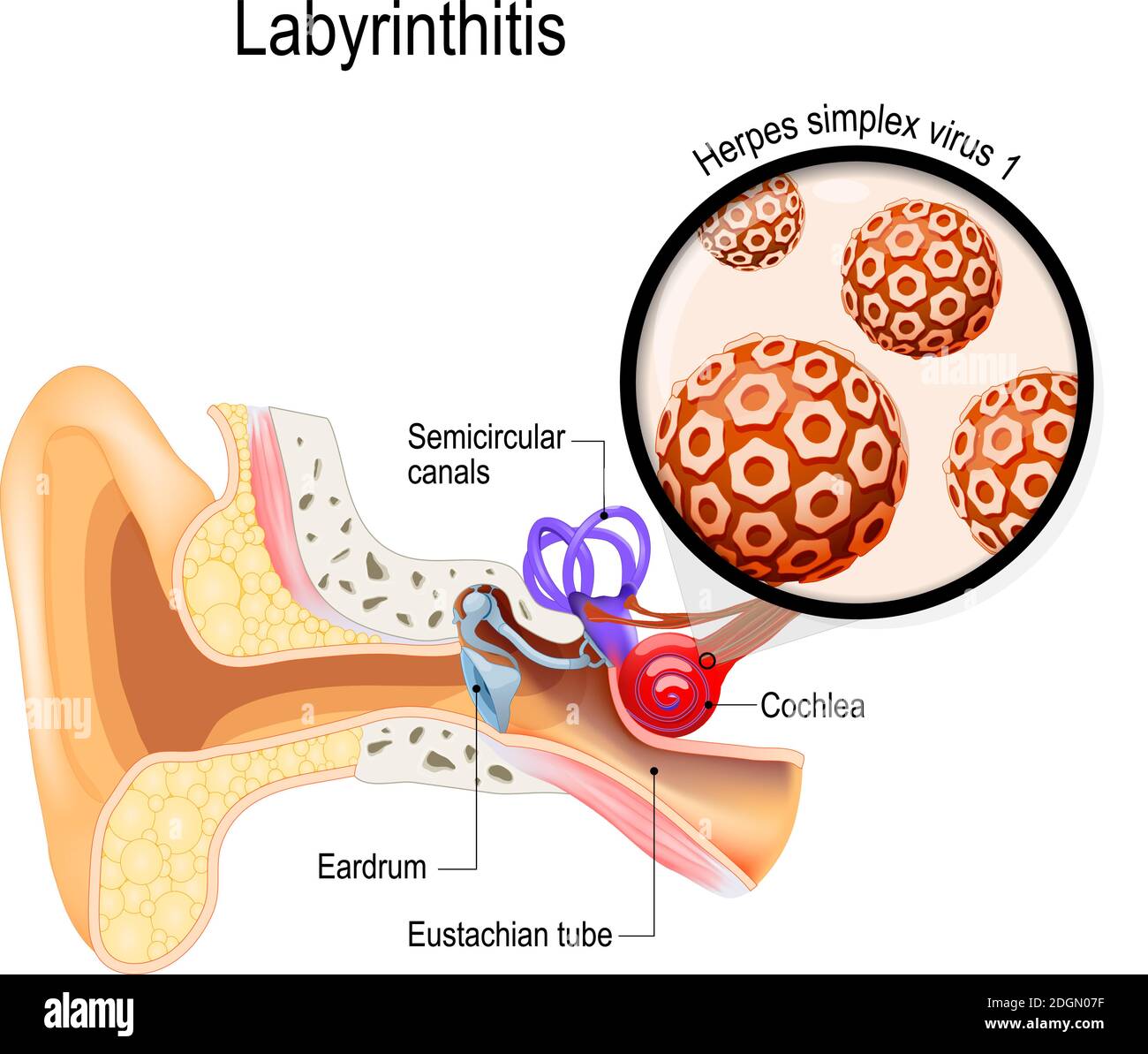 Labyrinthitis. vestibular neuritis. inflammation of the inner ear and virus that caused this disease. Herpes simplex virus. Human anatomy. Vector Stock Vector