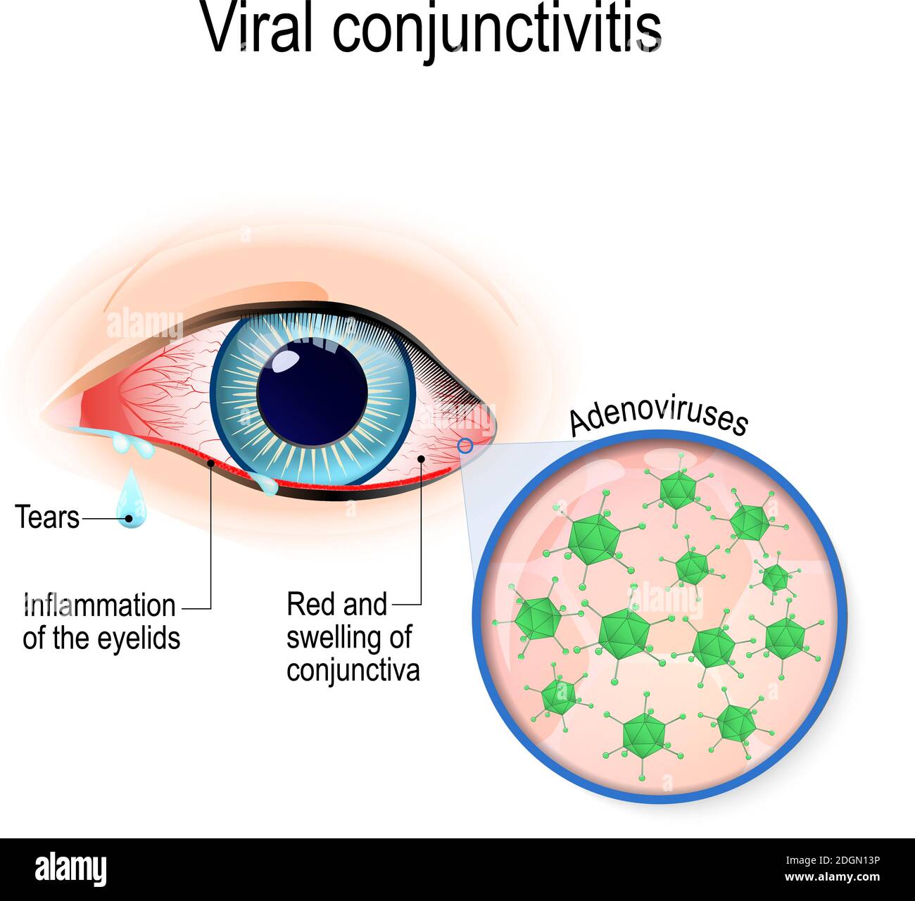 Viral conjunctivitis. Adenoviruses is the cause of viral conjunctivitis Stock Vector