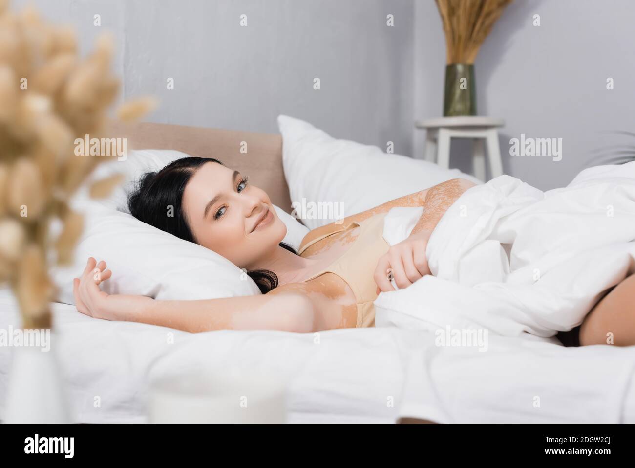 https://c8.alamy.com/comp/2DGW2CJ/young-happy-woman-with-vitiligo-lying-on-bed-with-blurred-foreground-2DGW2CJ.jpg