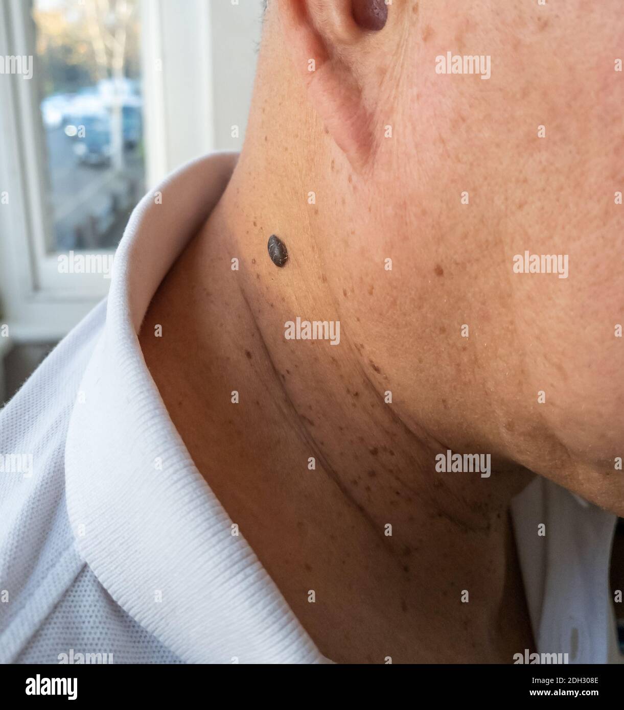 A skin mole normally as a result of exposure to ultraviolet light which can develop into Melanoma, a type of skin cancer. Stock Photo