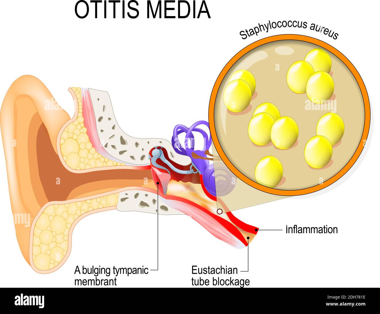 Otitis media is inflammation of the middle ear. bacterial infections disease. Close up of  Staphylococcus aureus. Human anatomy. illustration Stock Vector