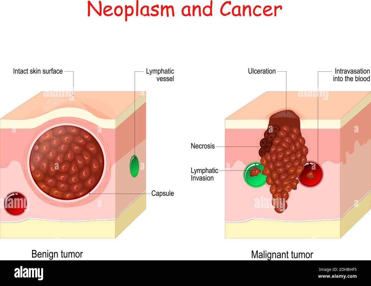 Cancer and Neoplasm. comparison and difference between Malignant and Benign tumor. Benign tumor has a Capsule. Cells of Malignant tumor have Necrosis Stock Vector