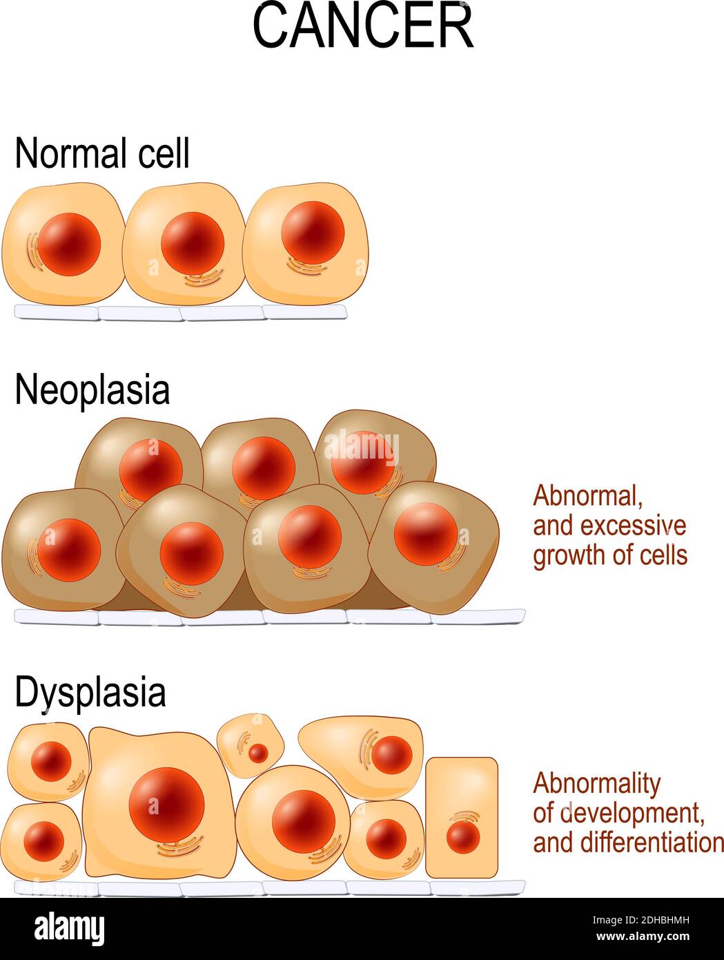 Normal cells, Dysplasia (abnormality of development, and differentiation), and Neoplasia (Abnormal, and excessive growth of cells). different. Vector Stock Vector
