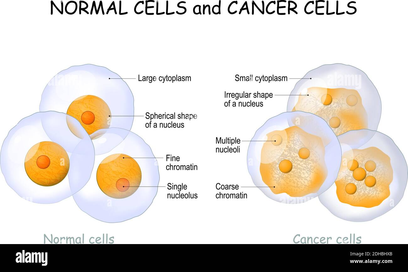Cancer cells and Normal cells. comparison and difference between healthy tissue and tumor. details about chromatin, nucleus and cytoplasm. Stock Vector