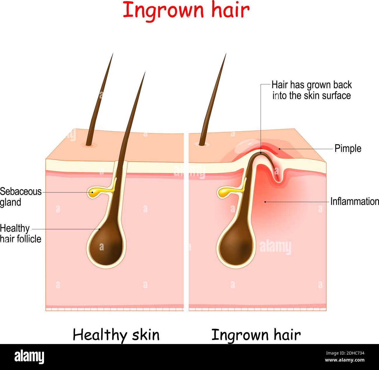 Ingrown hair hi-res stock photography and images - Alamy Ingrown hair hi-res stock photography and images - Alamy