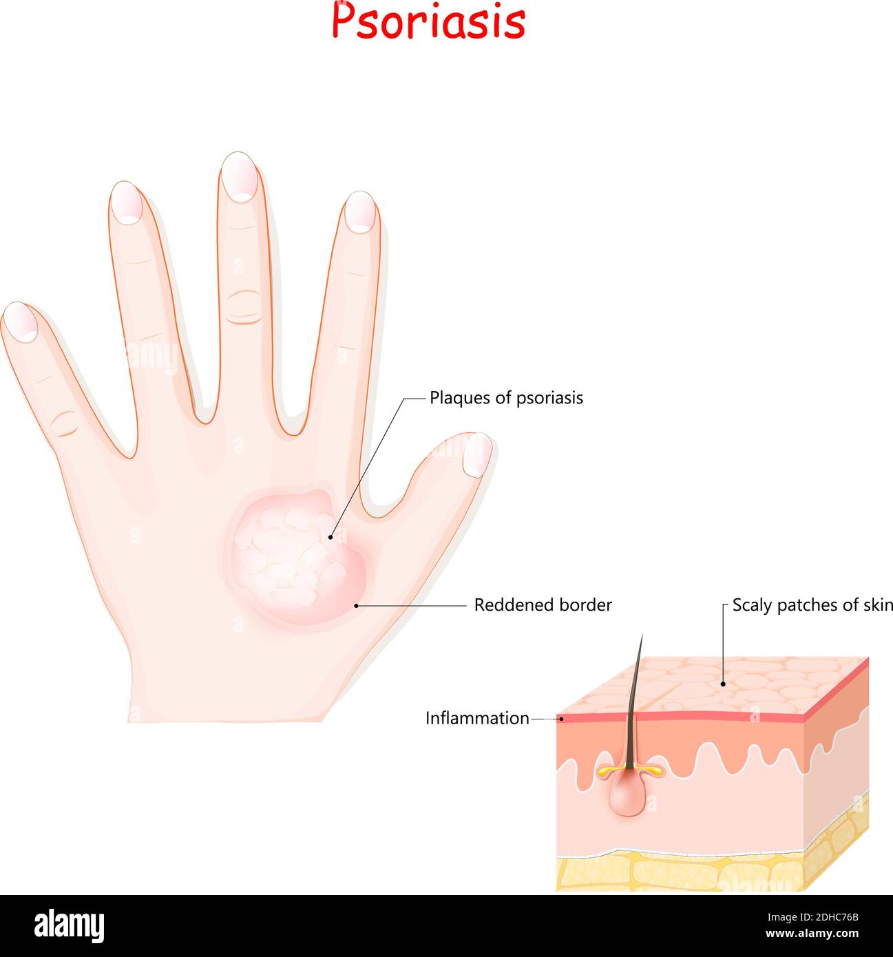 psoriasis of human hand. Symptoms of disease. Cross section layers of