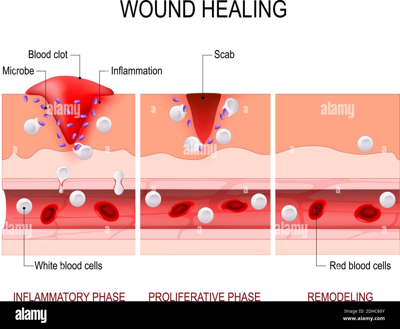 wound healing process. Hemostasis, Inflammatory, Proliferative, Maturation and remodeling. Tissue injury and inflammation. Immune system. vector Stock Vector