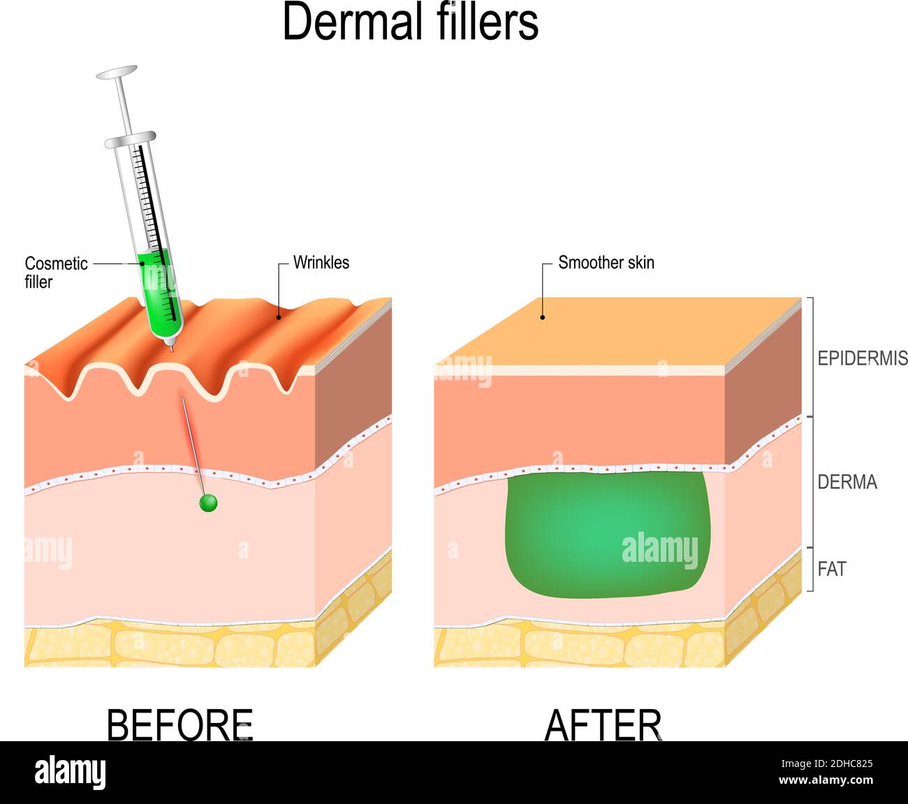 injectable cosmetic filler. How it works. Procedure. Before and after injection. Stock Vector