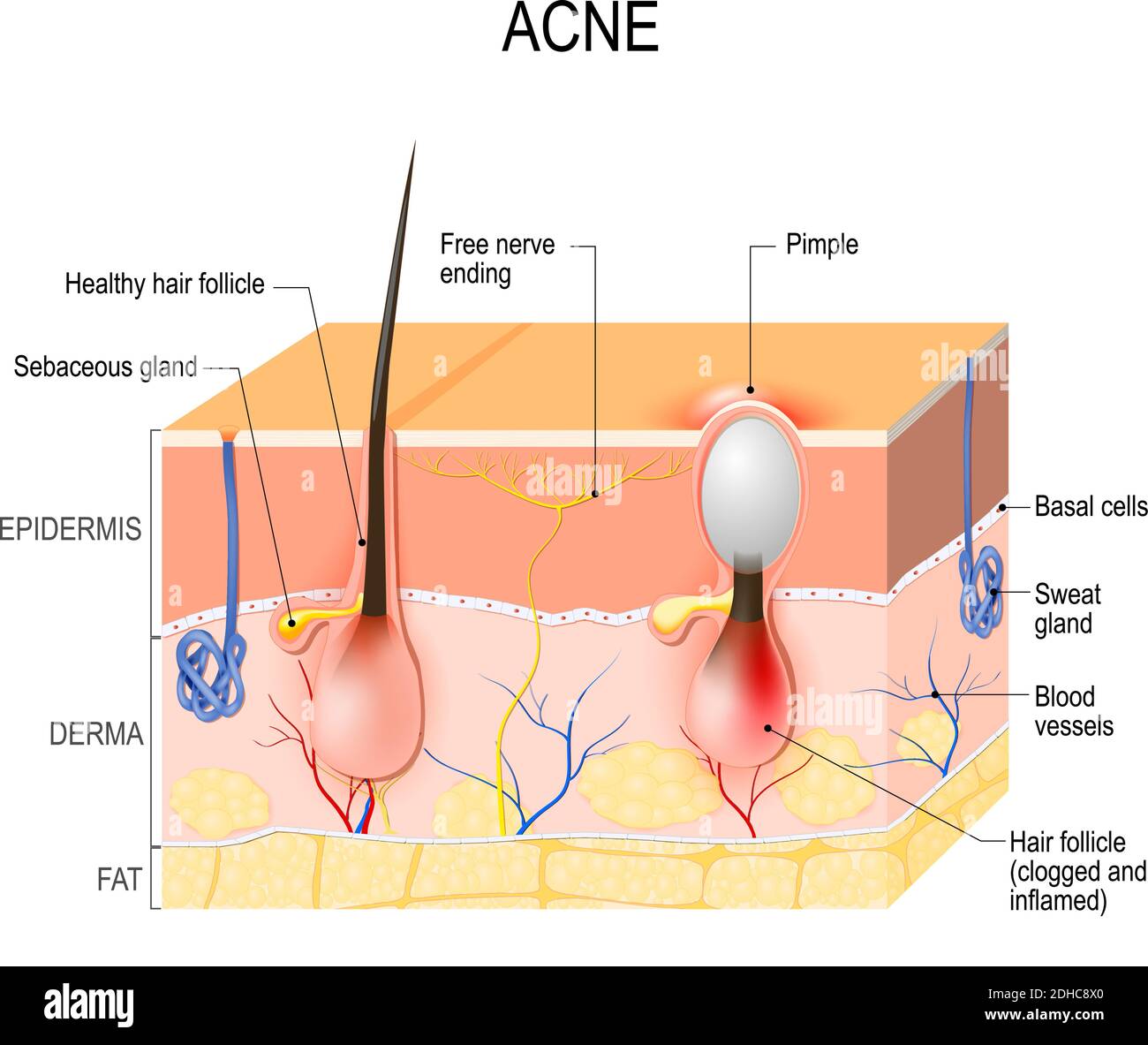 Acne vulgaris or pimple. healthy hair follicle and clogged pore. The sebum  and dead skin cells in the clogged pore promotes the growth Stock Vector  Image & Art - Alamy