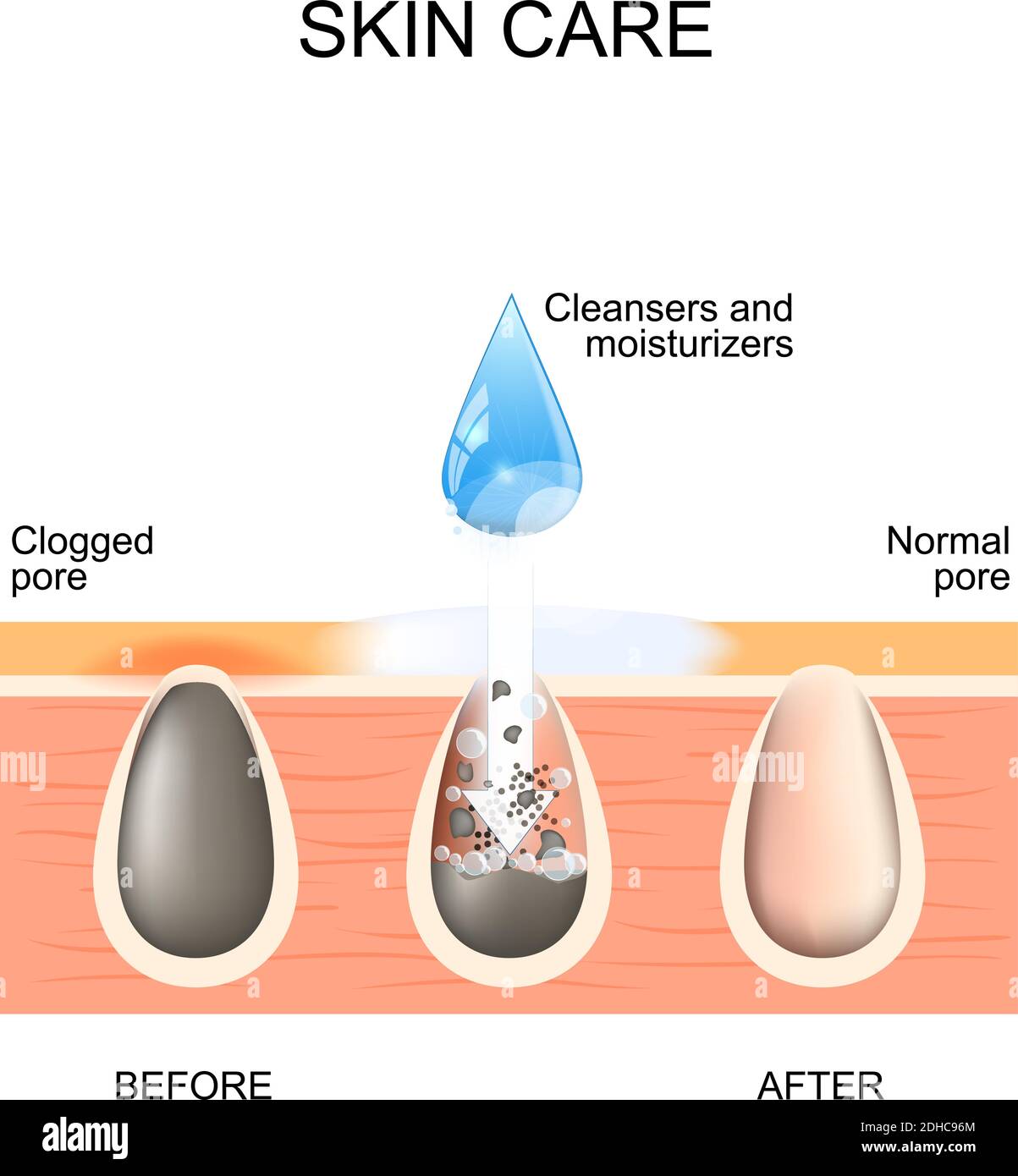 Skin care. Clogged and normal pores. Before and after using scrubs, cleansers and moisturizers Stock Vector