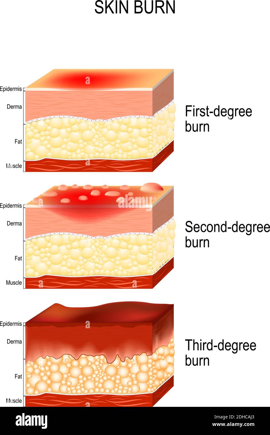 skin burn. Three degrees of burns. type of injury to skin. step of burn Stock Vector